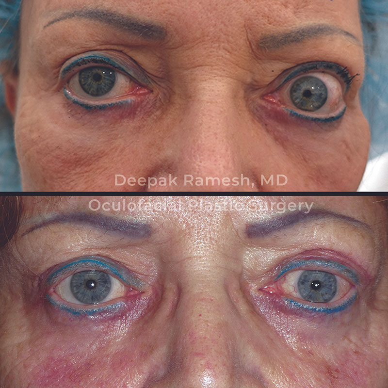 before and after orbital decompression in New Jersey