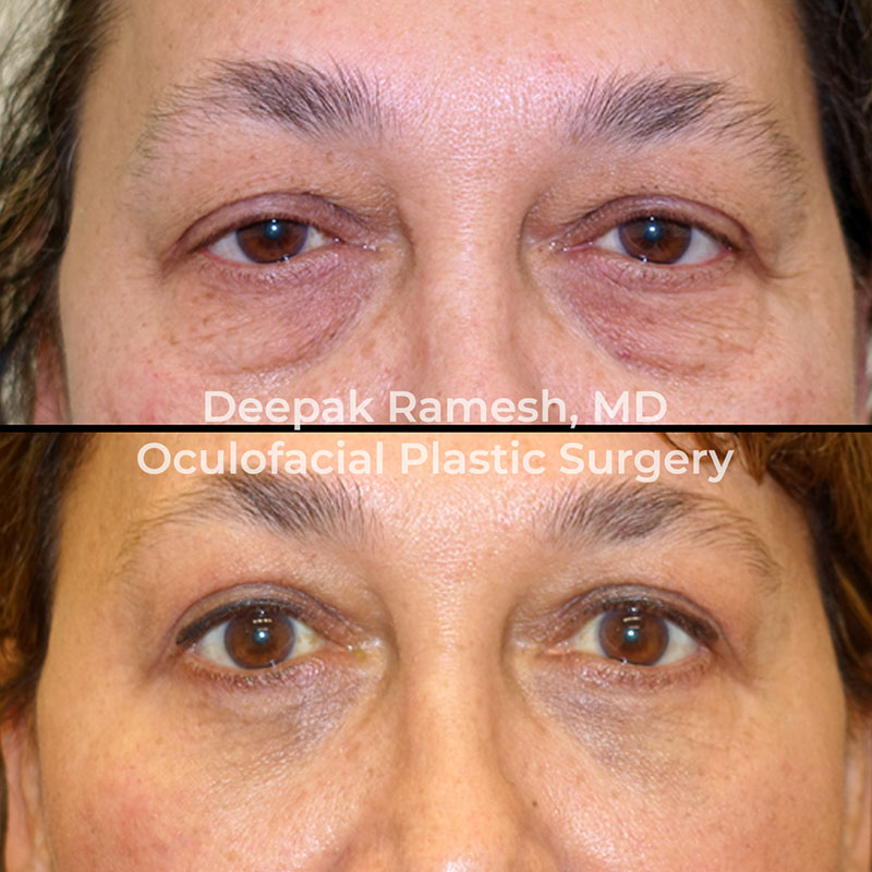 Before and after blepharoplasty in New Jersey, no longer having bags under the eyes and no longer having low eyelids.