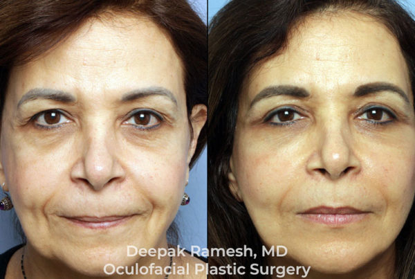before and after facelift in New Jersey