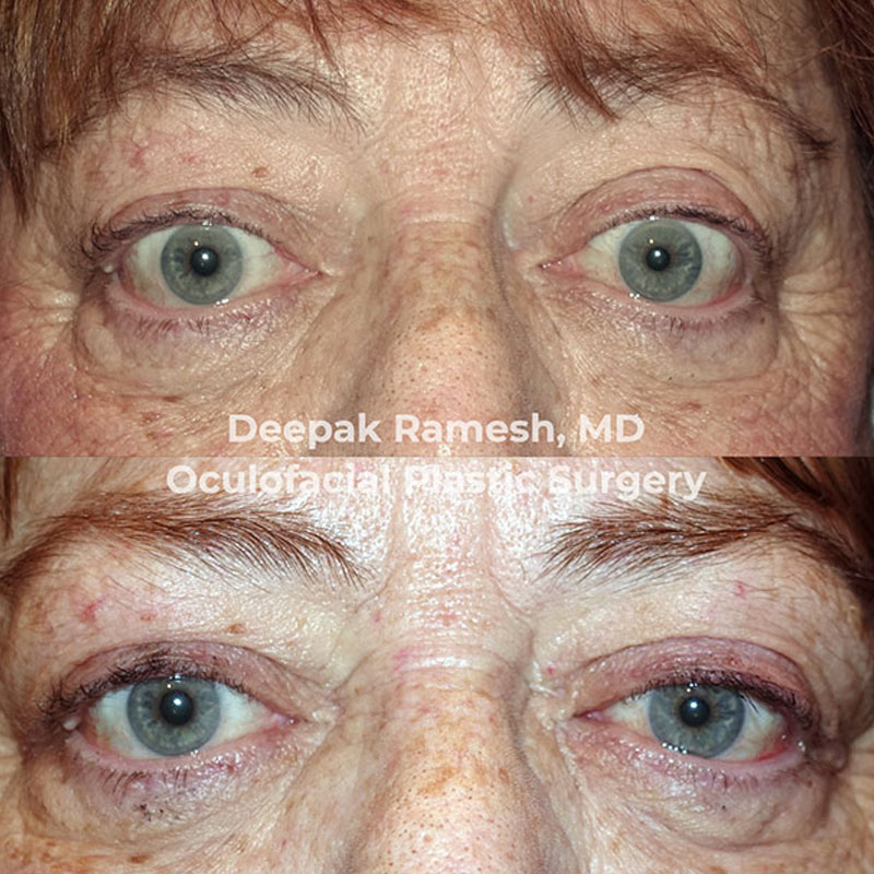 before and after orbital decompression in New Jersey