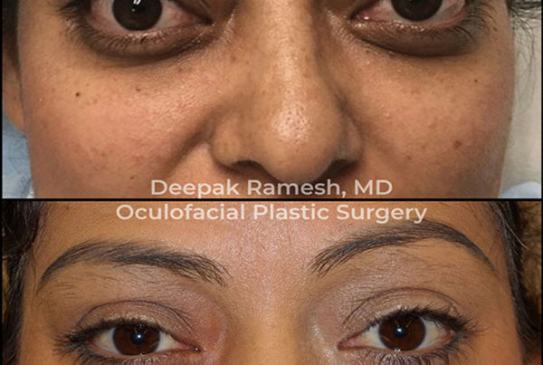 before and after from our oculoplastic surgeon New Jersey