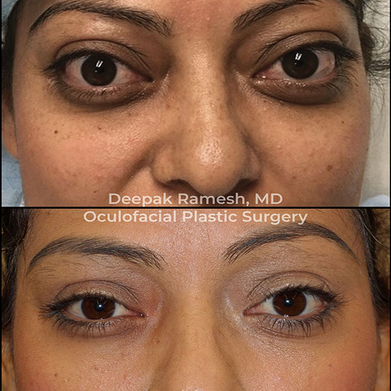 before and after from our oculoplastic surgeon New Jersey