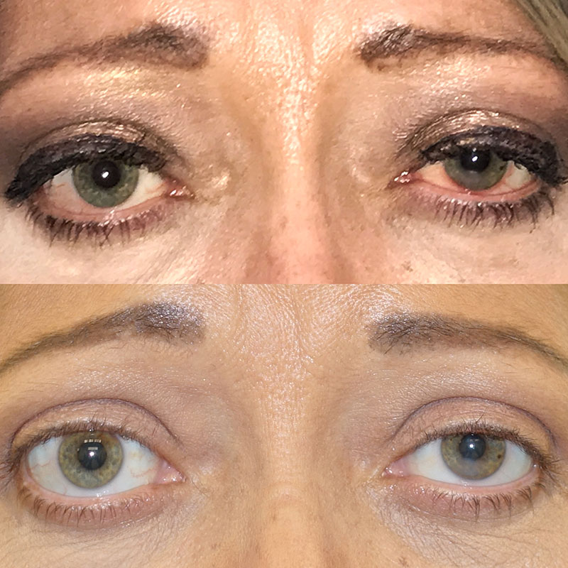 Tepezza in Somerset, NJ | Center for Eye & Facial Plastic Surgery