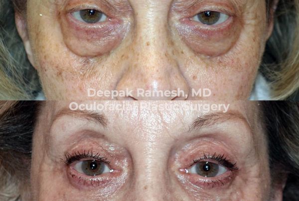Before and after eyelid surgery in New Jersey, showing that she no longer has bags under her eyes.