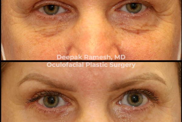 Before and after blepharoplasty in New Jersey, with under-eye bags now gone.
