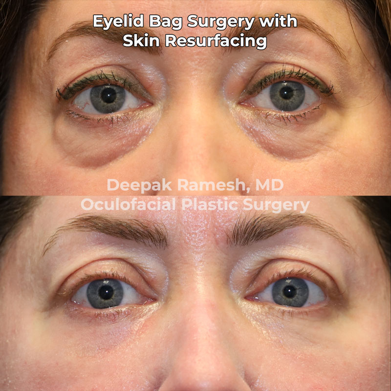 Skin Resurfacing In New Jersey Center For Eye Facial Plastic Surgery blepharoplasty-price-online-cityofclovis