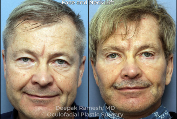 before and after facelift in New Jersey