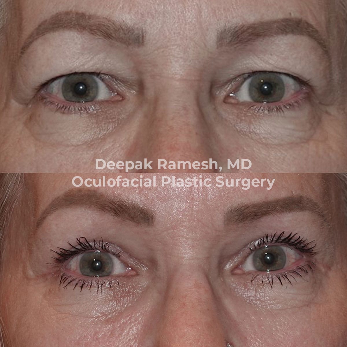 before and after from our oculoplastic surgeon New Jersey