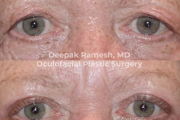 before and after from our oculoplastic surgeon New Jersey