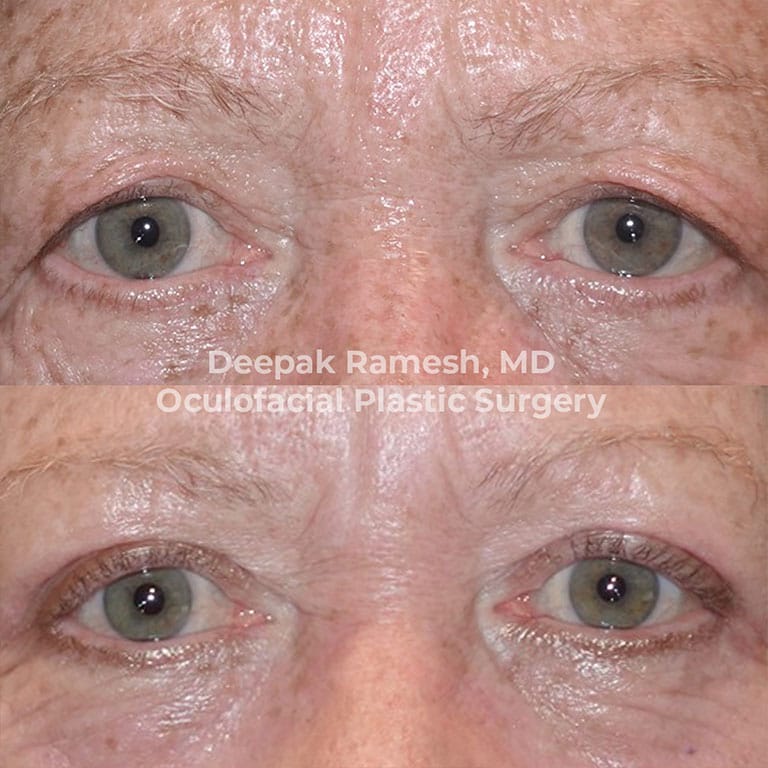 before and after from our oculoplastic surgeon New Jersey