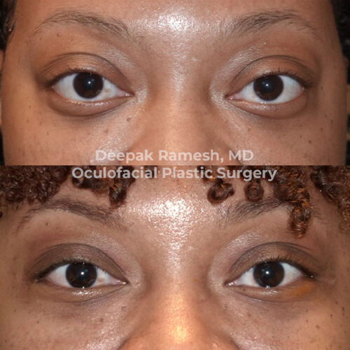 Gorgeous Orbital Decompression Eye Surgery Artwork Art Gorgeous Orbital Decompression Eye Surgery Artwork Art