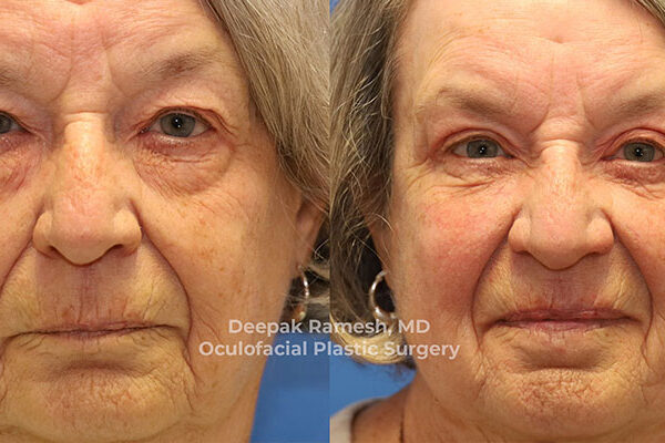 eyelid and eyebrow lift