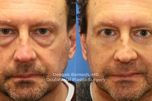 male surgery