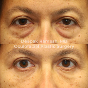 Lower Blepharoplasty in Somerset, NJ | Dr. Deepak Ramesh