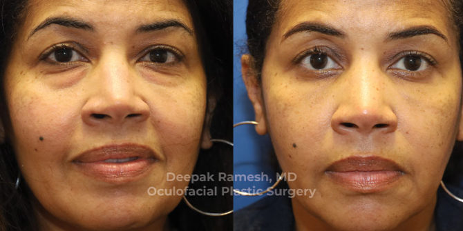 Lower Blepharoplasty in Somerset, NJ | Dr. Deepak Ramesh