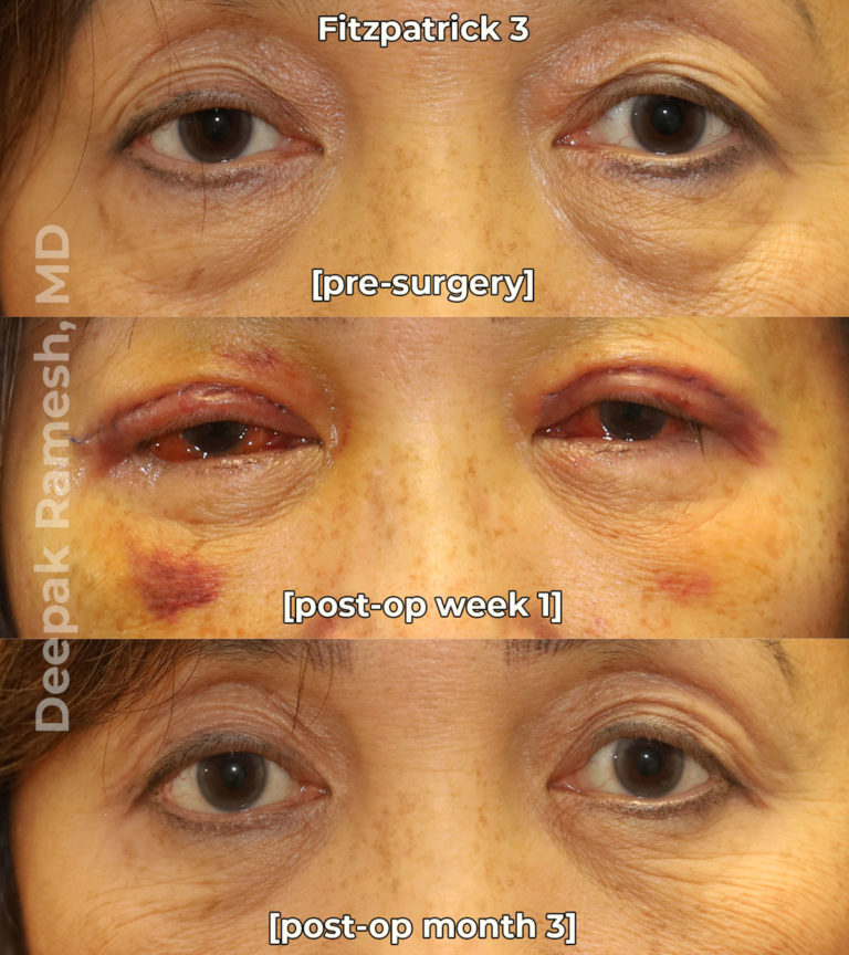 Recovery from Eyelid Surgery New Jersey | Dr. Deepak Ramesh