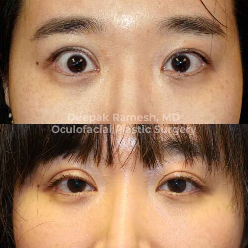 Eyelid Retraction Center for Eye and Facial Plastic Surgery