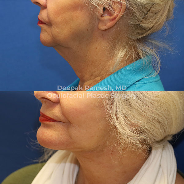 woman before and after neck lift in New Jersey