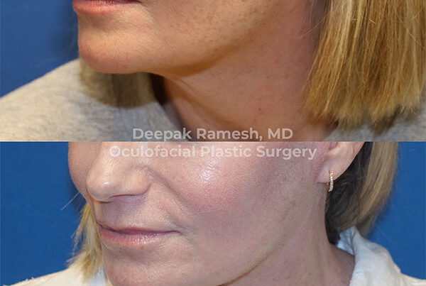 woma before and after neck lift in New Jersey
