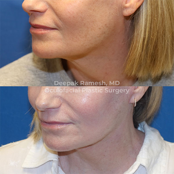 woma before and after neck lift in New Jersey