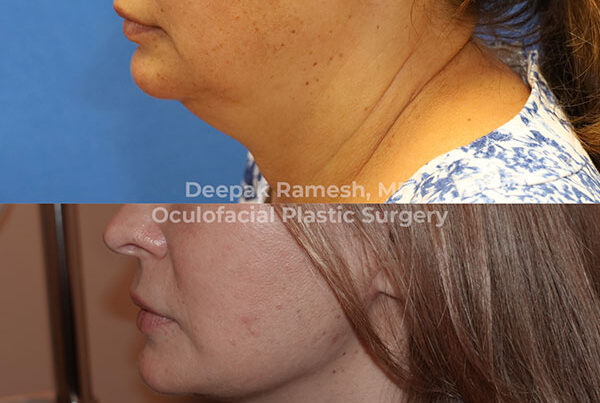 woman before and after neck lift in New Jersey