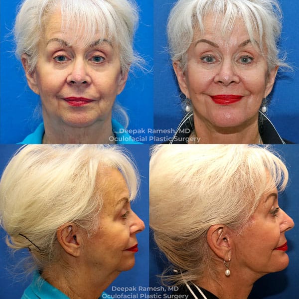 before and after neck lift in Somerset County, New Jersey