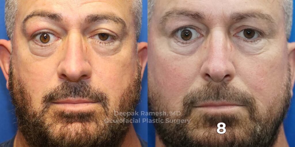 Tepezza - Center for Eye and Facial Plastic Surgery