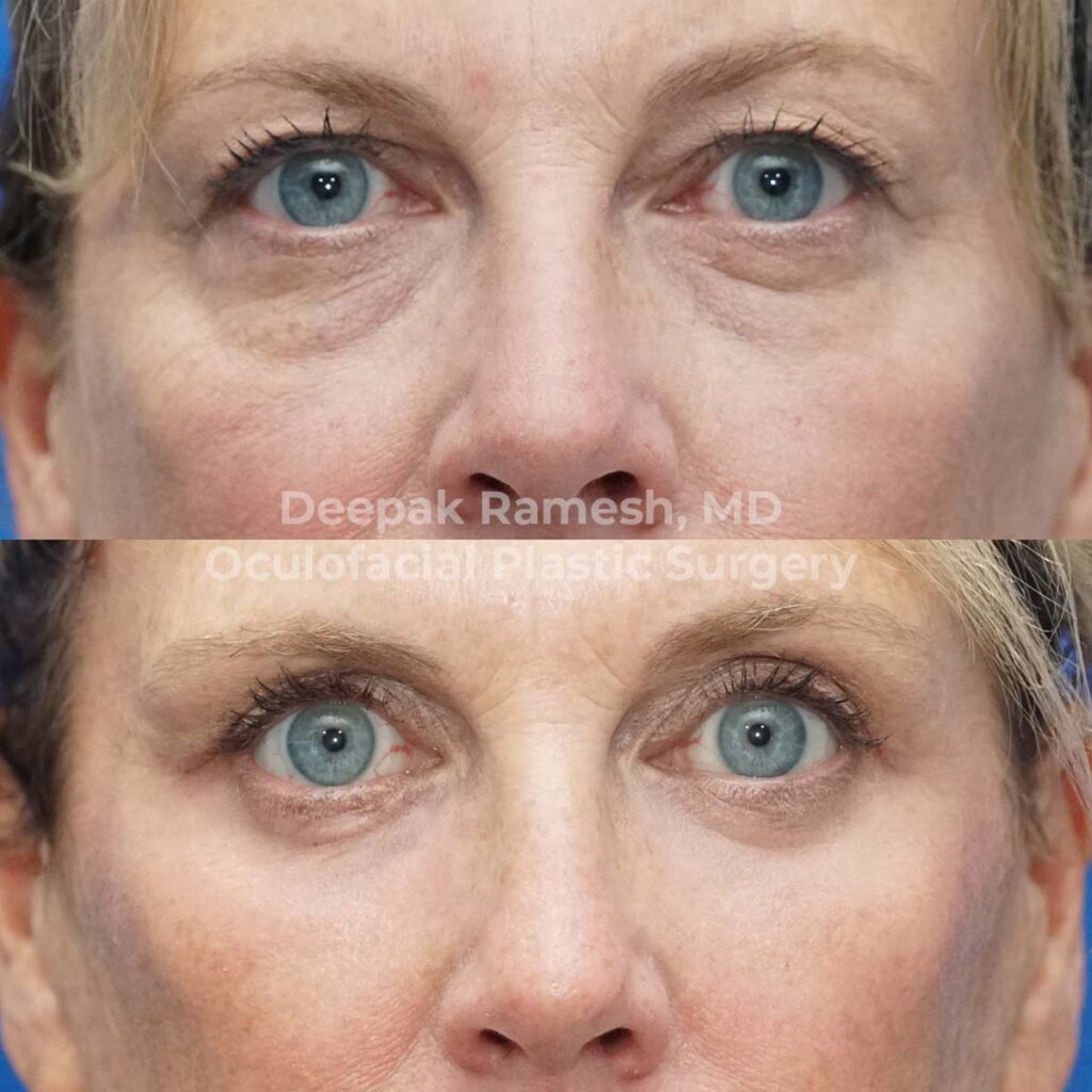 Eyelid + Eyebrow Lift Center for Eye and Facial Plastic Surgery