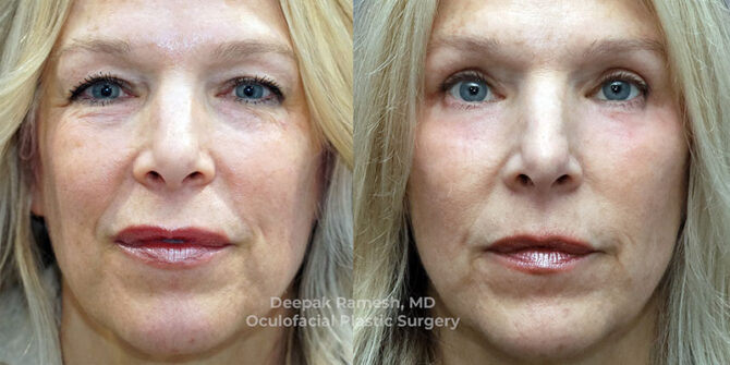 Eyelid Eyebrow Center for Eye andPlastic Surgery