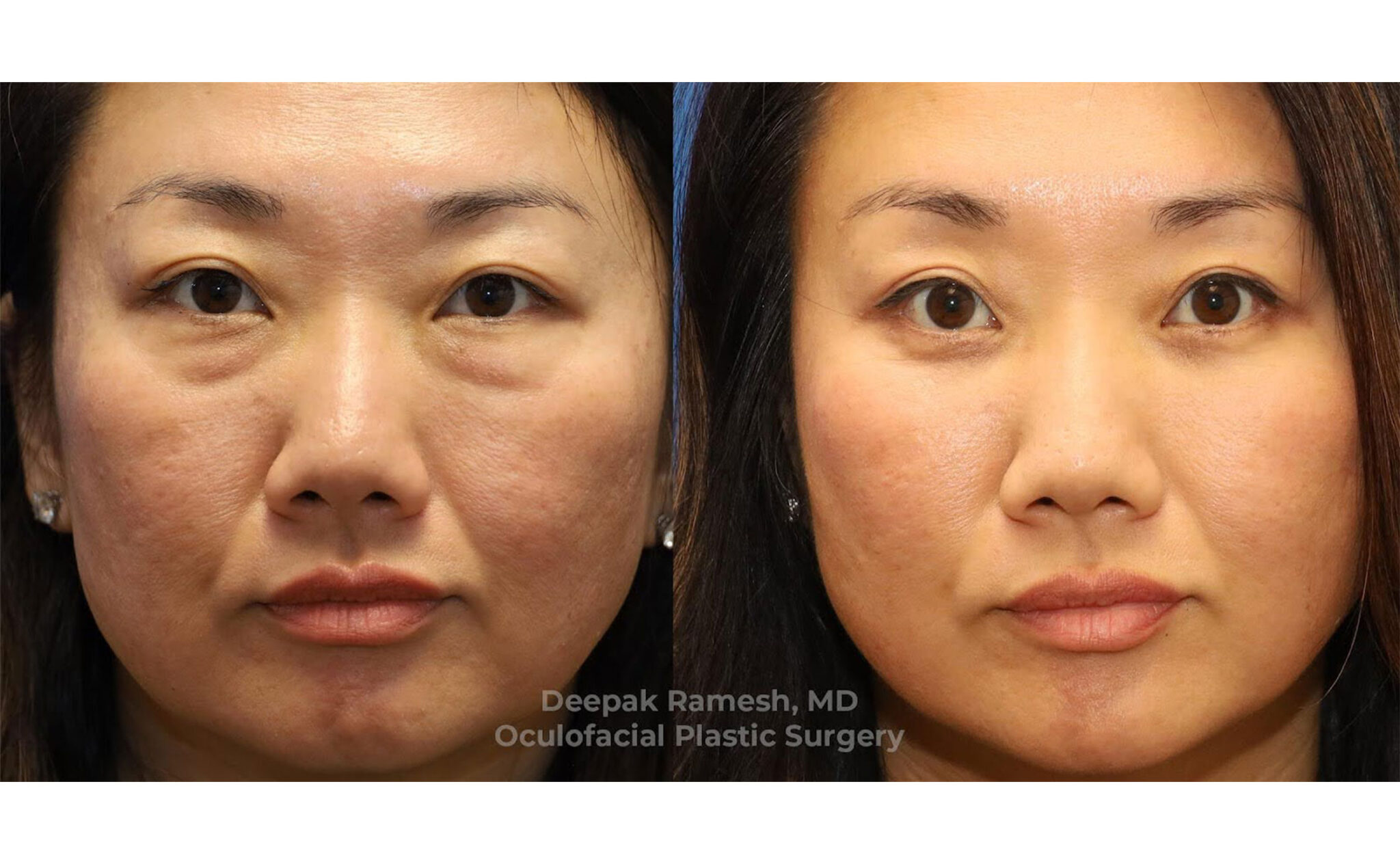 Eyelid Bag Surgery in New Jersey | Dr. Deepak Ramesh