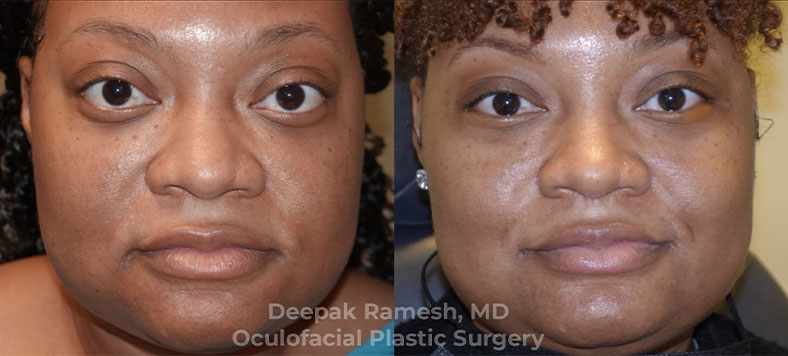 cosmetic-orbital-decompression-9-