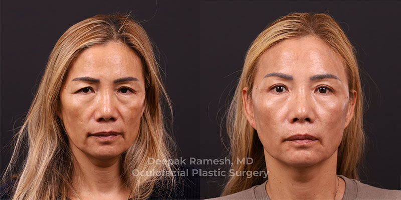 Blepharoplasty & Brow Lift