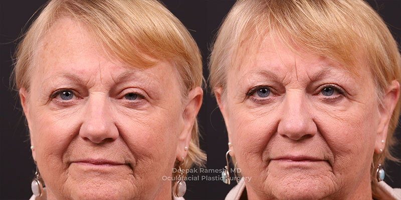 Blepharoplasty & Brow Lift