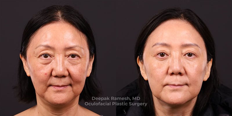 Asian Eyelid