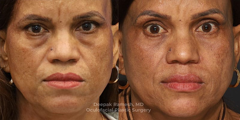 Blepharoplasty & Brow Lift