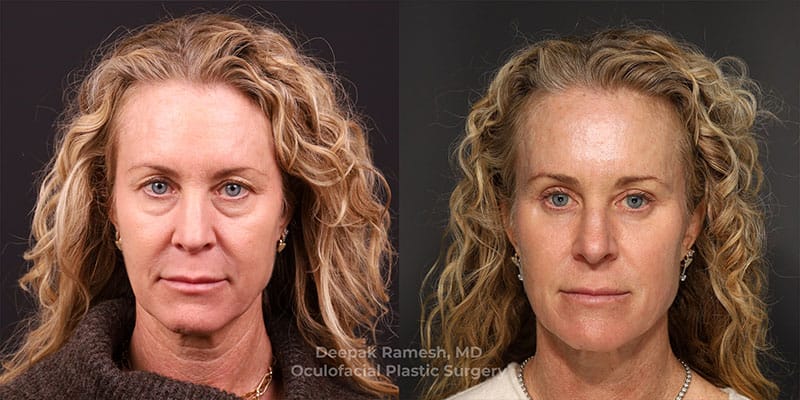 Blepharoplasty & Brow Lift