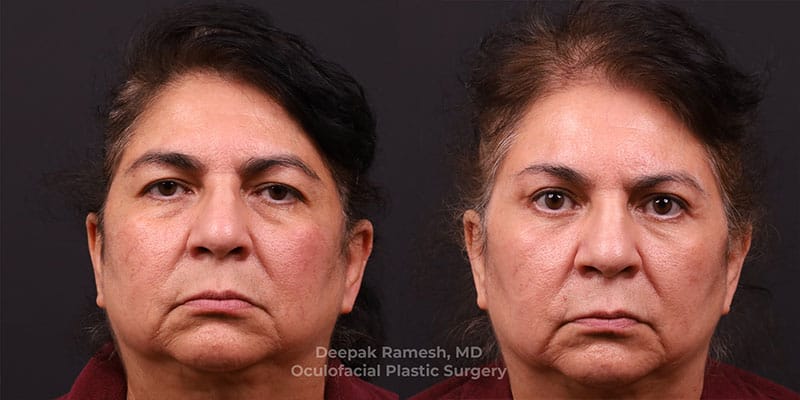 Blepharoplasty & Brow Lift