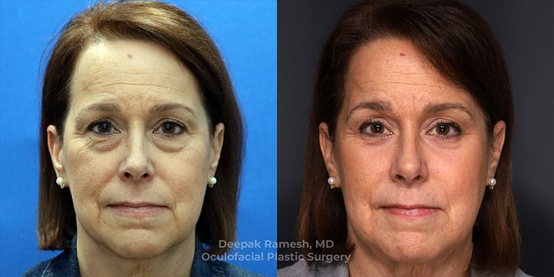 Blepharoplasty & Brow Lift