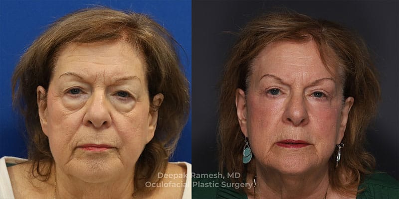 Blepharoplasty & Brow Lift