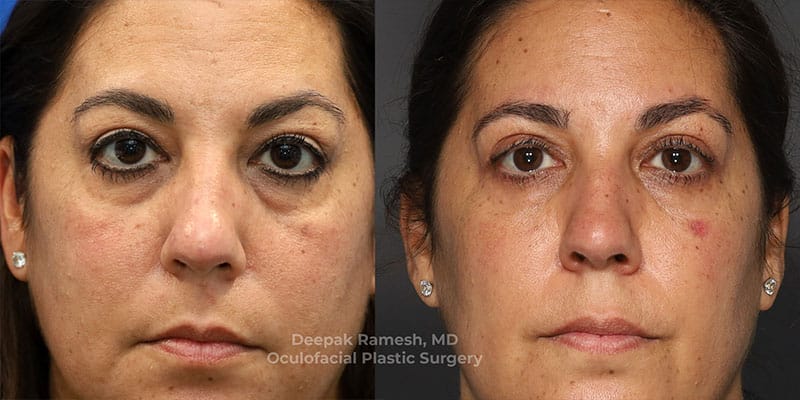 Blepharoplasty & Brow Lift