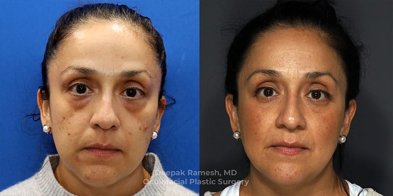 Blepharoplasty & Brow Lift