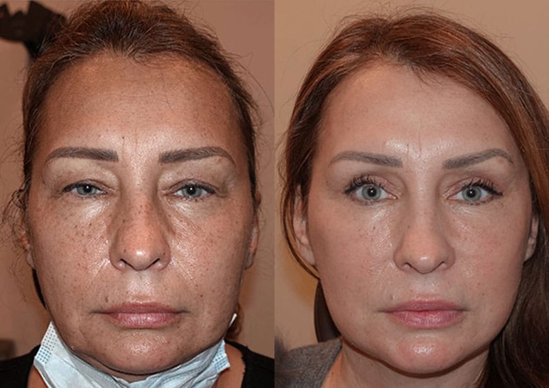 face-and-neck-5 Before and after facelift New Jersey results, woman with smoother, more youthful facial contours
