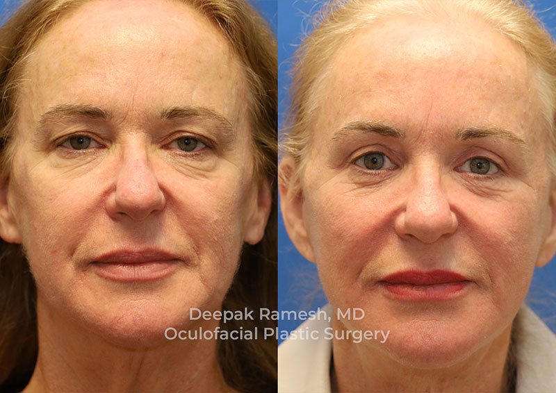 face-and-neck-6 Facelift New Jersey before and after, front view of woman with improved skin tightness and jawline