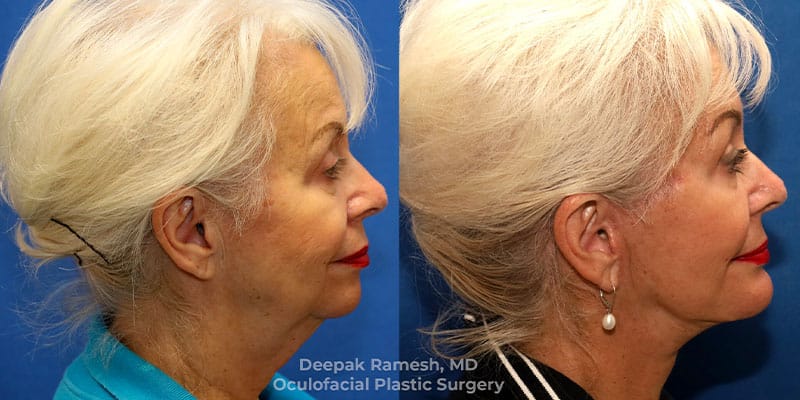 face-lift-face-neck-fat-transfer-13b Side profile before and after neck lift in New Jersey, woman with tighter jawline and reduced sagging skin