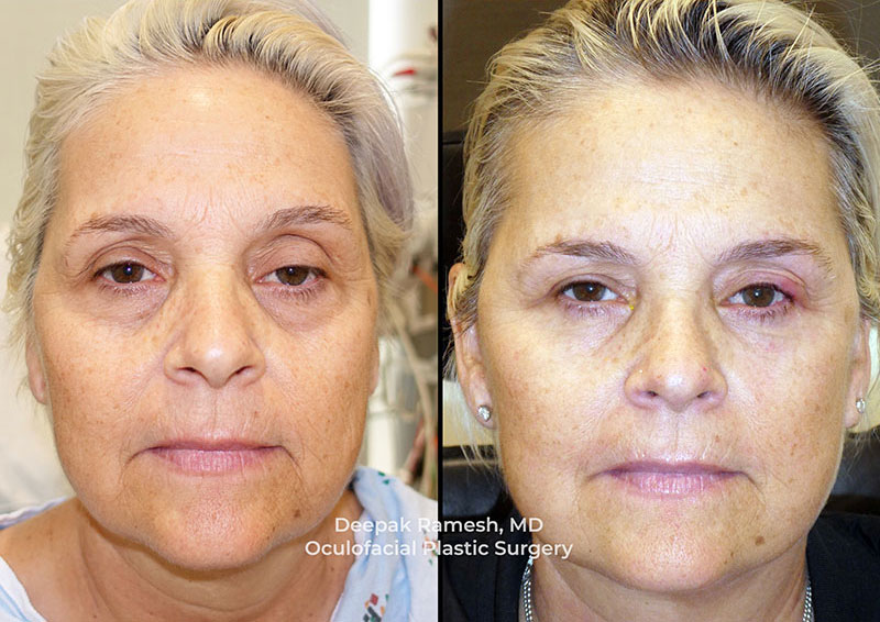 face-neck-ba-2f Facelift New Jersey before and after, front view of woman with rejuvenated under-eye and cheek area