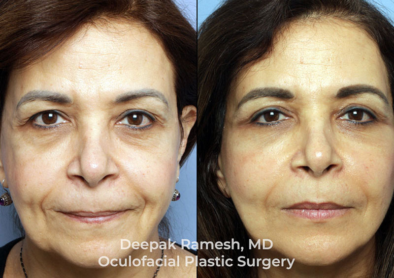 face-neck-ba-3f Before and after facelift New Jersey patient, woman with smoother forehead and reduced under-eye bags