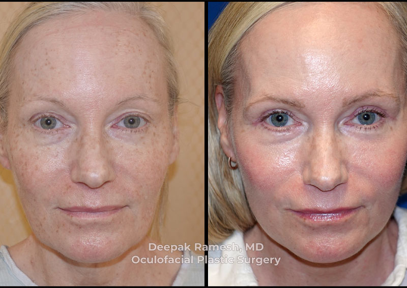 face-neck-gallery-ba-v2 a Neck lift in New Jersey before and after gallery photo, woman with brighter, tighter facial skin