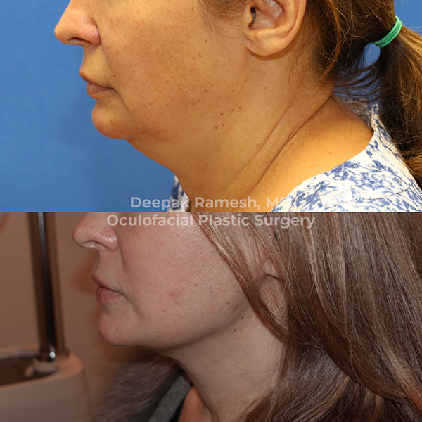 neck-lift-3 Side profile before and after neck lift in New Jersey, woman with reduced double chin and firmer jawline