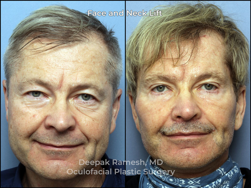 why-choose-dr-ramesh-face-neck-v2 Face and neck lift in New Jersey before and after, front view of male patient with firmer jawline